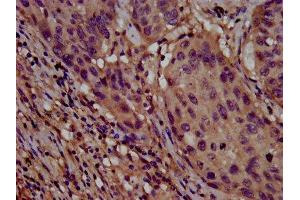 IHC image of ABIN7147931 diluted at 1:800 and staining in paraffin-embedded human lung cancer performed on a Leica BondTM system.