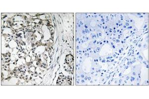 Immunohistochemistry analysis of paraffin-embedded human breast carcinoma tissue using PEX14 antibody.