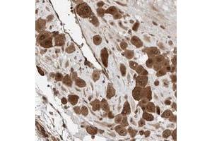 Immunohistochemical staining of human placenta with KIAA1009 polyclonal antibody  shows strong cytoplasmic and nuclear membranous positivity in decidual cells at 1:500-1:1000 dilution. (KIAA1009 (KIAA1009) antibody)
