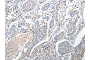 The image on the left is immunohistochemistry of paraffin-embedded Human lung cancer tissue using ABIN7190682(FOXD1 Antibody) at dilution 1/25, on the right is treated with synthetic peptide. (FOXD1 antibody)