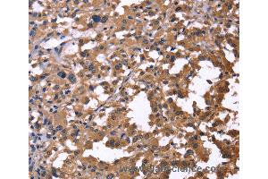 Immunohistochemistry of Human thyroid cancer using IL1A Polyclonal Antibody at dilution of 1:60 (IL1A antibody)