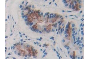 Detection of FBLN4 in Human Stomach cancer Tissue using Polyclonal Antibody to Fibulin 4 (FBLN4) (FBLN4 antibody  (AA 26-443))
