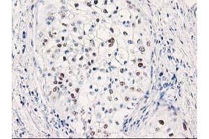 Immunohistochemical staining of paraffin-embedded Carcinoma of Human pancreas tissue using anti-TP53 mouse monoclonal antibody. (p53 antibody)