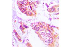 Immunohistochemical analysis of NGEP staining in human lung cancer formalin fixed paraffin embedded tissue section. (Anoctamin 7 antibody  (C-Term))