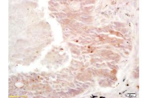 Formalin-fixed and paraffin embedded human lung carcinoma labeled with Rabbit Anti Cullin/C10orf46 Polyclonal Antibody, Unconjugated (ABIN670896) at 1:200 followed by conjugation to the secondary antibody and DAB staining (CACUL1 antibody  (AA 181-248))