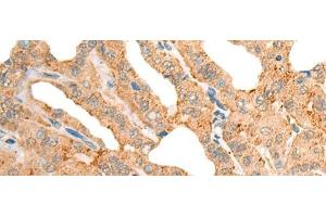 Immunohistochemistry of paraffin-embedded Human thyroid cancer tissue using CECR1 Polyclonal Antibody at dilution of 1:40(x200) (CECR1 antibody)