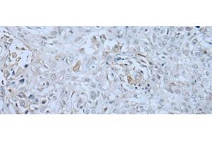 Immunohistochemistry of paraffin-embedded Human lung cancer tissue using HUWE1 Polyclonal Antibody at dilution of 1:30(x200) (HUWE1 antibody)