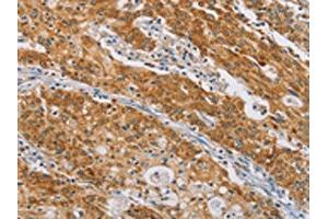 The image on the left is immunohistochemistry of paraffin-embedded Human gastic cancer tissue using ABIN7190211(CENPE Antibody) at dilution 1/50, on the right is treated with synthetic peptide. (CENPE antibody)
