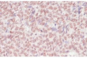Immunohistochemistry of paraffin-embedded Human oophoroma using SNRNP70 Polyclonal Antibody at dilution of 1:100 (40x lens).