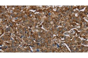 Immunohistochemistry of paraffin-embedded Human liver cancer using ARHGDIA Polyclonal Antibody at dilution of 1:30 (ARHGDIA antibody)