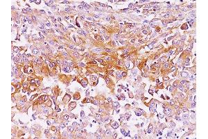 Formalin-fixed, paraffin-embedded human Melanoma stained with gp100 Monoclonal Antibody (SPM286). (Melanoma gp100 antibody)