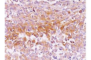 Formalin-fixed, paraffin-embedded human Melanoma stained with gp100 Monoclonal Antibody (SPM286).