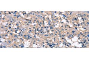 Immunohistochemistry of paraffin-embedded Human thyroid cancer tissue using ZFYVE16 Polyclonal Antibody at dilution of 1:60(x200) (ZFYVE16 antibody)