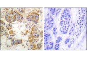 Immunohistochemistry analysis of paraffin-embedded human breast carcinoma tissue, using Collagen I Antibody.