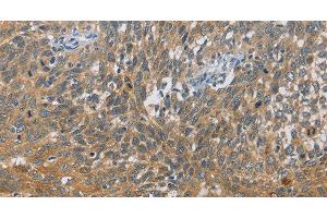 Immunohistochemistry of paraffin-embedded Human cervical cancer tissue using DIO1 Polyclonal Antibody at dilution 1:60 (DIO1 antibody)