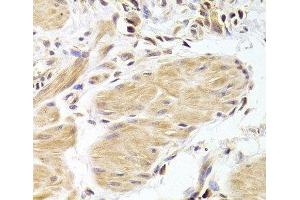 Immunohistochemistry of paraffin-embedded Human gastric cancer using Caspase-2 Polyclonal Antibody at dilution of 1:100 (40x lens). (Caspase 2 antibody)