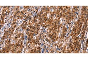 Immunohistochemistry of paraffin-embedded Human gasrtic cancer tissue using TDP2 Polyclonal Antibody at dilution 1:40 (TDP2 antibody)