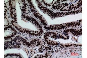 Immunohistochemistry (IHC) analysis of paraffin-embedded Human Colon Cancer, antibody was diluted at 1:100. (SIGLEC7 antibody  (Internal Region))