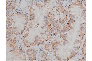 ABIN6267496 at 1/200 staining Human lung cancer tissue sections by IHC-P. (SNCA antibody  (pSer129))
