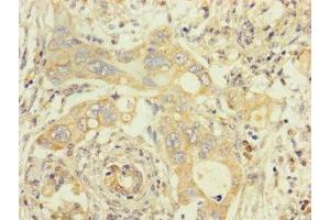 Immunohistochemistry of paraffin-embedded human pancreatic cancer using ABIN7173107 at dilution of 1:100