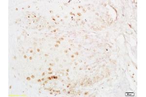 Formalin-fixed and paraffin embedded human esophageal carcinoma labeled with Anti-ELAVL1/HUR Polyclonal Antibody, Unconjugated (ABIN748583) at 1:200 followed by conjugation to the secondary antibody and DAB staining (ELAVL1 antibody)