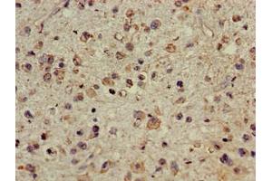 Immunohistochemistry of paraffin-embedded human glioma using ABIN7147710 at dilution of 1:100 (CDYL antibody  (AA 8-260))