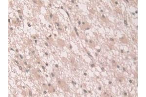 Detection of GCA in Human Glioma Tissue using Polyclonal Antibody to Grancalcin (GCA) (Grancalcin antibody  (AA 1-139))