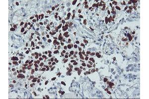 Immunohistochemical staining of paraffin-embedded Carcinoma of Human lung tissue using anti-TP53 mouse monoclonal antibody. (p53 antibody)