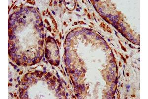 IHC image of ABIN7156872 diluted at 1:1400 and staining in paraffin-embedded human prostate cancer performed on a Leica BondTM system. (IL-24 antibody  (AA 52-207))