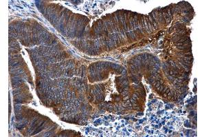 IHC-P Image IL1 Receptor 2 antibody [N3C3] detects IL1 Receptor 2 protein at cytoplasm in human colon cancer by immunohistochemical analysis. (IL1R2 antibody)