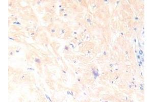 Detection of IL13 in Human Prostate Tissue using Polyclonal Antibody to Interleukin 13 (IL13) (IL-13 antibody  (AA 25-146))