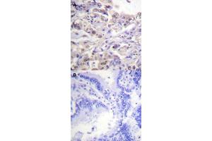 Immunohistochemical staining (Formalin-fixed paraffin-embedded sections) of human lung cancer tissue with HNRNPD (phospho S83) polyclonal antibody  without blocking peptide (A) or preincubated with blocking peptide (B) under 1:50-1:100 dilution.