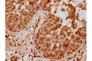 IHC image of ABIN7144464 diluted at 1:740 and staining in paraffin-embedded human breast cancer performed on a Leica BondTM system. (PYCARD antibody  (AA 1-195))