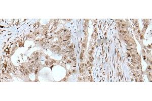 Immunohistochemistry of paraffin-embedded Human colorectal cancer tissue using USP3 Polyclonal Antibody at dilution of 1:50(x200) (USP3 antibody)