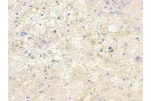 ABIN6255949 and ABIN6267455 at 1/100 staining human astrocytoma by IHC-P.