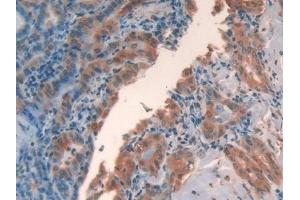 Detection of GAL2 in Human Thyroid cancer Tissue using Polyclonal Antibody to Galectin 2 (GAL2) (Galectin 2 antibody  (AA 1-132))