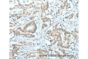 Immunohistochemistry of Human thyroid cancer using ASH2L Polyclonal Antibody at dilution of 1:60 (ASH2L antibody)
