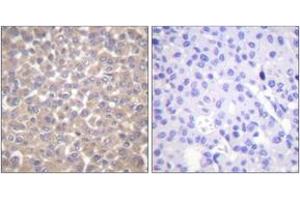 Immunohistochemistry analysis of paraffin-embedded human breast carcinoma tissue, using TRADD Antibody. (TRADD antibody  (AA 251-300))