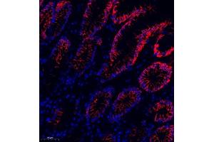 Immunofluorescence of paraffin embedded human colon cancer using MRP1 (ABIN7074544) at dilution of 1:1000 (250x lens) (MRP1 antibody)