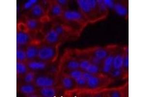 Immunofluorescence analysis of Human liver cancer tissue using ABCB5 Monoclonal Antibody at dilution of 1:200. (ABCB5 antibody)