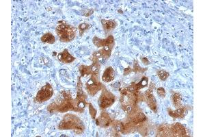 Formalin-fixed, paraffin-embedded human Hepatocellular Carcinoma stained with Serum Amyloid A Mouse Monoclonal Antibody (SAA/326). (SAA antibody)