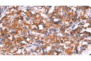 Immunohistochemistry of paraffin-embedded Human thyroid cancer using GH1 Polyclonal Antibody at dilution of 1:40 (Growth Hormone 1 antibody)