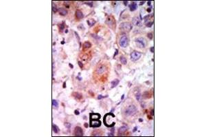 Formalin-fixed and paraffin-embedded human cancer tissue reacted with the primary antibody, which was peroxidase-conjugated to the secondary antibody, followed by AEC staining. (GRK2 antibody  (C-Term))