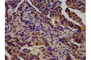 IHC image of ABIN7168933 diluted at 1:400 and staining in paraffin-embedded human lung cancer performed on a Leica BondTM system. (SPINK6 antibody  (AA 24-80))