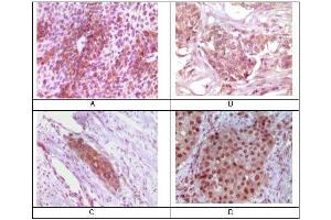 Immunohistochemical analysis of paraffin-embedded human bladder carcinoma (A), breast carcinoma (B), esophagus carcinoma (C), skin carcinoma (D) tissue, showing cytoplasmic localization using Rab25 mouse mAb with DAB staining. (RAB25 antibody)