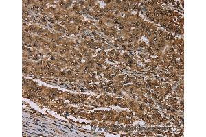 Immunohistochemistry of Human thyroid cancer using MEIS1 Polyclonal Antibody at dilution of 1:30