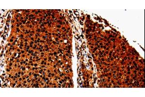 Immunohistochemistry of paraffin-embedded Human renal cancer tissue using ANXA7 Polyclonal Antibody at dilution 1:40 (Annexin VII antibody)