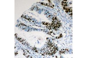 Immunohistochemical analysis of Cyclin E1 (pT395) staining in human colon cancer formalin fixed paraffin embedded tissue section. (Cyclin E1 antibody  (C-Term, pSer395))
