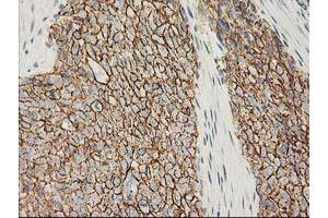 Immunohistochemical staining of paraffin-embedded Adenocarcinoma of Human breast tissue using anti-CTNNB1 mouse monoclonal antibody. (CTNNB1 antibody)