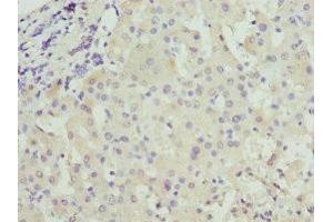 Immunohistochemistry of paraffin-embedded human liver cancer using ABIN7146036 at dilution of 1:100 (CRP antibody  (AA 19-224))
